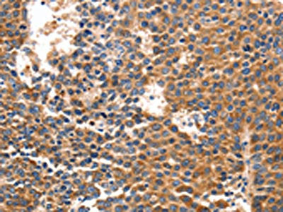 The image on the left is immunohistochemistry of paraffin-embedded Human liver cancer tissue using CSB-PA090613(IRF1 Antibody) at dilution 1/40, on the right is treated with synthetic peptide. (Original magnification: ×200)