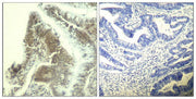 Immunohistochemical analysis of paraffin-embedded human colon carcinoma tissue using CDK6(Ab-13) Antibody(left) or the same antibody preincubated with blocking peptide(right).