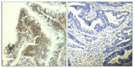 Immunohistochemical analysis of paraffin-embedded human colon carcinoma tissue using CDK6(Ab-13) Antibody(left) or the same antibody preincubated with blocking peptide(right).