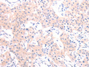 The image on the left is immunohistochemistry of paraffin-embedded Human lung cancer tissue using CSB-PA090698(HCRT Antibody) at dilution 1/20, on the right is treated with synthetic peptide. (Original magnification: ×200)