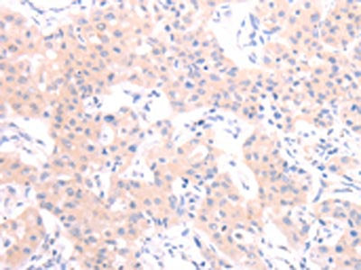 The image on the left is immunohistochemistry of paraffin-embedded Human lung cancer tissue using CSB-PA090698(HCRT Antibody) at dilution 1/20, on the right is treated with synthetic peptide. (Original magnification: ×200)