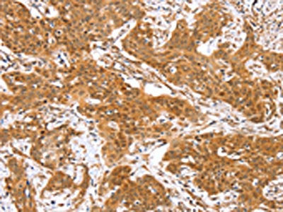 The image on the left is immunohistochemistry of paraffin-embedded Human cervical cancer tissue using CSB-PA090738(RGS22 Antibody) at dilution 1/40, on the right is treated with fusion protein. (Original magnification: ×200)
