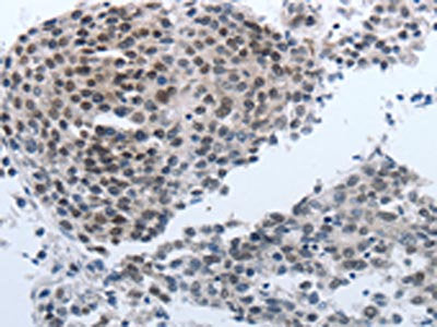 The image on the left is immunohistochemistry of paraffin-embedded Human liver cancer tissue using CSB-PA090777(NPR1 Antibody) at dilution 1/40, on the right is treated with synthetic peptide. (Original magnification: ×200)