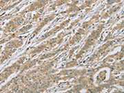 The image on the left is immunohistochemistry of paraffin-embedded Human gastic cancer tissue using CSB-PA090786(EEF2 Antibody) at dilution 1/20, on the right is treated with fusion protein. (Original magnification: ×200)