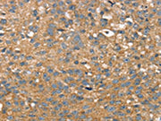 The image on the left is immunohistochemistry of paraffin-embedded Human breast cancer tissue using CSB-PA090875(TWF1 Antibody) at dilution 1/25, on the right is treated with fusion protein. (Original magnification: ×200)
