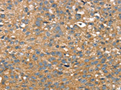 The image on the left is immunohistochemistry of paraffin-embedded Human breast cancer tissue using CSB-PA090875(TWF1 Antibody) at dilution 1/25, on the right is treated with fusion protein. (Original magnification: ×200)