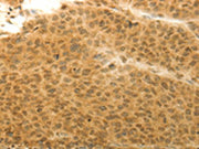 The image on the left is immunohistochemistry of paraffin-embedded Human liver cancer tissue using CSB-PA090969(HOXA4 Antibody) at dilution 1/20, on the right is treated with synthetic peptide. (Original magnification: ×200)