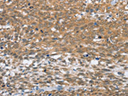 The image on the left is immunohistochemistry of paraffin-embedded Human cervical cancer tissue using CSB-PA091025(MLH1 Antibody) at dilution 1/60, on the right is treated with fusion protein. (Original magnification: ×200)