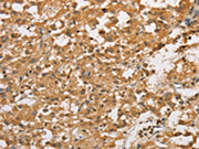 The image on the left is immunohistochemistry of paraffin-embedded Human thyroid cancer tissue using CSB-PA091163(ARHGEF5 Antibody) at dilution 1/50, on the right is treated with fusion protein. (Original magnification: ×200)
