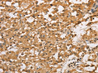 The image on the left is immunohistochemistry of paraffin-embedded Human thyroid cancer tissue using CSB-PA091163(ARHGEF5 Antibody) at dilution 1/50, on the right is treated with fusion protein. (Original magnification: ×200)