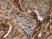 The image on the left is immunohistochemistry of paraffin-embedded Human lung cancer tissue using CSB-PA091165(CALD1 Antibody) at dilution 1/35, on the right is treated with fusion protein. (Original magnification: ×200)