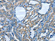 The image on the left is immunohistochemistry of paraffin-embedded Human thyroid cancer tissue using CSB-PA091269(ADCK4 Antibody) at dilution 1/30, on the right is treated with fusion protein. (Original magnification: ×200)