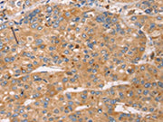 The image on the left is immunohistochemistry of paraffin-embedded Human liver cancer tissue using CSB-PA091535(SLC25A38 Antibody) at dilution 1/25, on the right is treated with synthetic peptide. (Original magnification: ×200)