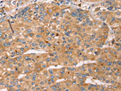 The image on the left is immunohistochemistry of paraffin-embedded Human liver cancer tissue using CSB-PA091535(SLC25A38 Antibody) at dilution 1/25, on the right is treated with synthetic peptide. (Original magnification: ×200)