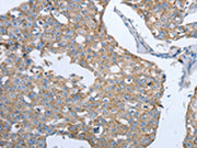 The image on the left is immunohistochemistry of paraffin-embedded Human breast cancer tissue using CSB-PA091551(MMP19 Antibody) at dilution 1/15, on the right is treated with synthetic peptide. (Original magnification: ×200)