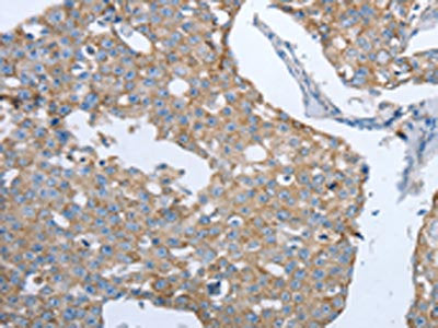 The image on the left is immunohistochemistry of paraffin-embedded Human breast cancer tissue using CSB-PA091551(MMP19 Antibody) at dilution 1/15, on the right is treated with synthetic peptide. (Original magnification: ×200)