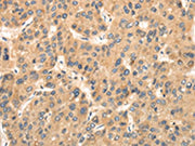 The image on the left is immunohistochemistry of paraffin-embedded Human liver cancer tissue using CSB-PA091574(TTC23 Antibody) at dilution 1/35, on the right is treated with fusion protein. (Original magnification: ×200)