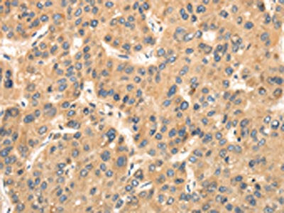 The image on the left is immunohistochemistry of paraffin-embedded Human liver cancer tissue using CSB-PA091574(TTC23 Antibody) at dilution 1/35, on the right is treated with fusion protein. (Original magnification: ×200)