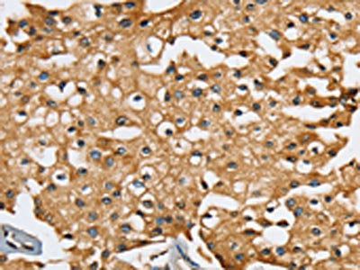 The image on the left is immunohistochemistry of paraffin-embedded Human prostate cancer tissue using CSB-PA091643(SEC14L2 Antibody) at dilution 1/25, on the right is treated with synthetic peptide. (Original magnification: ×200)