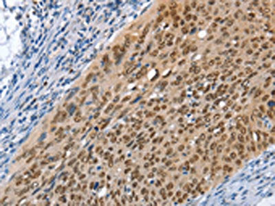 The image on the left is immunohistochemistry of paraffin-embedded Human cervical cancer tissue using CSB-PA091656(MCM6 Antibody) at dilution 1/45, on the right is treated with fusion protein. (Original magnification: ×200)