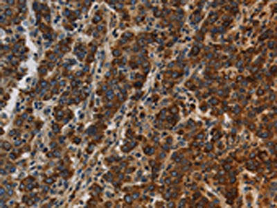 The image on the left is immunohistochemistry of paraffin-embedded Human liver cancer tissue using CSB-PA091770(CCR8 Antibody) at dilution 1/20, on the right is treated with synthetic peptide. (Original magnification: ×200)