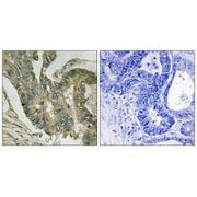 Immunohistochemistry analysis of paraffin-embedded human colon carcinoma tissue using ALDOC antibody.
