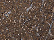 The image on the left is immunohistochemistry of paraffin-embedded Human ovarian cancer tissue using CSB-PA091932(HOXC8 Antibody) at dilution 1/25, on the right is treated with synthetic peptide. (Original magnification: ×200)