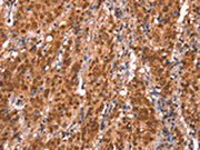The image on the left is immunohistochemistry of paraffin-embedded Human gastic cancer tissue using CSB-PA092041(KCNJ6 Antibody) at dilution 1/20, on the right is treated with synthetic peptide. (Original magnification: ×200)