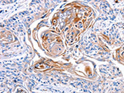 The image on the left is immunohistochemistry of paraffin-embedded Human esophagus cancer tissue using CSB-PA092112(CX3CL1 Antibody) at dilution 1/30, on the right is treated with synthetic peptide. (Original magnification: ×200)