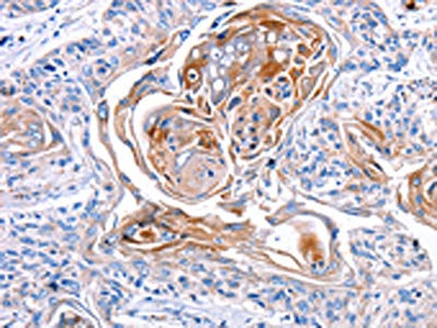 The image on the left is immunohistochemistry of paraffin-embedded Human esophagus cancer tissue using CSB-PA092112(CX3CL1 Antibody) at dilution 1/30, on the right is treated with synthetic peptide. (Original magnification: ×200)