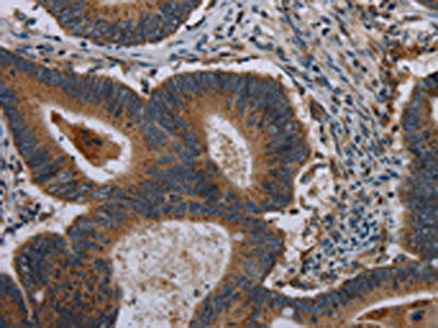The image on the left is immunohistochemistry of paraffin-embedded Human colon cancer tissue using CSB-PA092285(MAP3K11 Antibody) at dilution 1/40, on the right is treated with synthetic peptide. (Original magnification: ×200)