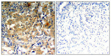 Immunohistochemical analysis of paraffin-embedded human lung carcinoma tissue using PKCζ (Phospho-Thr410) antibody.