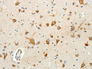 The image on the left is immunohistochemistry of paraffin-embedded Human brain tissue using CSB-PA092850(RPAP3 Antibody) at dilution 1/20, on the right is treated with fusion protein. (Original magnification: ×200)