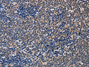 The image on the left is immunohistochemistry of paraffin-embedded Human lymphoma tissue using CSB-PA092883(ALG12 Antibody) at dilution 1/20, on the right is treated with fusion protein. (Original magnification: ×200)