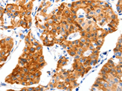 The image on the left is immunohistochemistry of paraffin-embedded Human lung cancer tissue using CSB-PA092898(SLC2A4 Antibody) at dilution 1/70, on the right is treated with synthetic peptide. (Original magnification: ×200)
