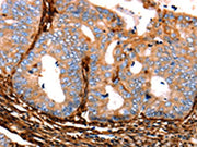 The image on the left is immunohistochemistry of paraffin-embedded Human cervical cancer tissue using CSB-PA092958(LGALS1 Antibody) at dilution 1/25, on the right is treated with fusion protein. (Original magnification: ×200)