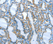 Immunohistochemical analysis of paraffin-embedded Human thyroid cancer tissue using at dilution 1/25.