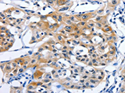 The image on the left is immunohistochemistry of paraffin-embedded Human lung cancer tissue using CSB-PA093051(GJB3 Antibody) at dilution 1/15, on the right is treated with synthetic peptide. (Original magnification: ×200)
