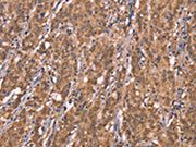 The image on the left is immunohistochemistry of paraffin-embedded Human gastic cancer tissue using CSB-PA093129(FBXO31 Antibody) at dilution 1/40, on the right is treated with synthetic peptide. (Original magnification: ×200)