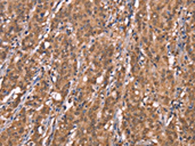 The image on the left is immunohistochemistry of paraffin-embedded Human gastic cancer tissue using CSB-PA093129(FBXO31 Antibody) at dilution 1/40, on the right is treated with synthetic peptide. (Original magnification: ×200)