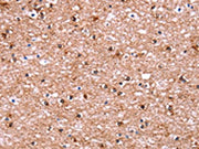 The image on the left is immunohistochemistry of paraffin-embedded Human brain tissue using CSB-PA093138(ADM2 Antibody) at dilution 1/40, on the right is treated with synthetic peptide. (Original magnification: ×200)