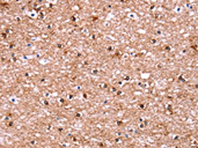 The image on the left is immunohistochemistry of paraffin-embedded Human brain tissue using CSB-PA093138(ADM2 Antibody) at dilution 1/40, on the right is treated with synthetic peptide. (Original magnification: ×200)