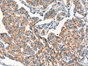 The image on the left is immunohistochemistry of paraffin-embedded Human breast cancer tissue using CSB-PA093388(DSP Antibody) at dilution 1/15, on the right is treated with synthetic peptide. (Original magnification: ×200)