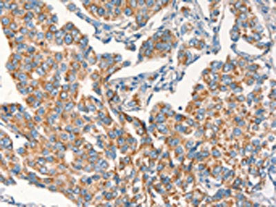 The image on the left is immunohistochemistry of paraffin-embedded Human breast cancer tissue using CSB-PA093388(DSP Antibody) at dilution 1/15, on the right is treated with synthetic peptide. (Original magnification: ×200)