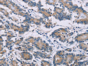 The image on the left is immunohistochemistry of paraffin-embedded Human colon cancer tissue using CSB-PA093441(ODF2 Antibody) at dilution 1/30, on the right is treated with fusion protein. (Original magnification: ×200)