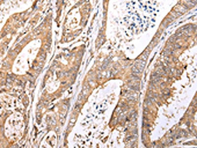 The image on the left is immunohistochemistry of paraffin-embedded Human colorectal cancer tissue using CSB-PA093573(XKR7 Antibody) at dilution 1/20, on the right is treated with synthetic peptide. (Original magnification: ×200)
