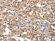 The image on the left is immunohistochemistry of paraffin-embedded Human thyroid cancer tissue using CSB-PA094054(DUSP2 Antibody) at dilution 1/30, on the right is treated with synthetic peptide. (Original magnification: ×200)