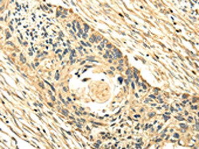 The image on the left is immunohistochemistry of paraffin-embedded Human esophagus cancer tissue using CSB-PA094064(PMP2 Antibody) at dilution 1/25, on the right is treated with fusion protein. (Original magnification: ×200)