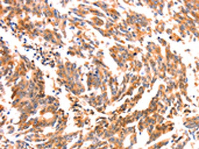 The image on the left is immunohistochemistry of paraffin-embedded Human gastic cancer tissue using CSB-PA094270(NES Antibody) at dilution 1/30, on the right is treated with synthetic peptide. (Original magnification: ×200)
