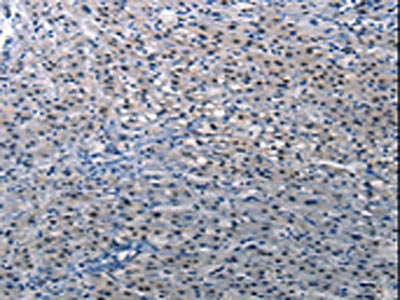 The image on the left is immunohistochemistry of paraffin-embedded Human liver cancer tissue using CSB-PA094273(DEFA1 Antibody) at dilution 1/10, on the right is treated with synthetic peptide. (Original magnification: ×200)